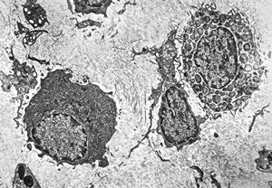 M,14y. | plasmocytoma - nasal cavity, plasmocyte and mastocyte